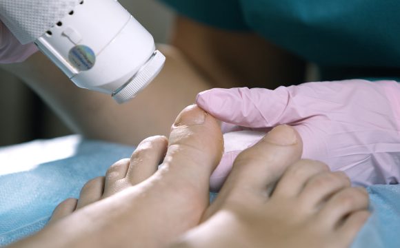 Onychomycosis Treatment