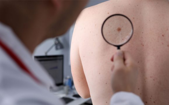 Skin Tag Removal
